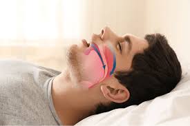 Sleep Apnea Treatment
